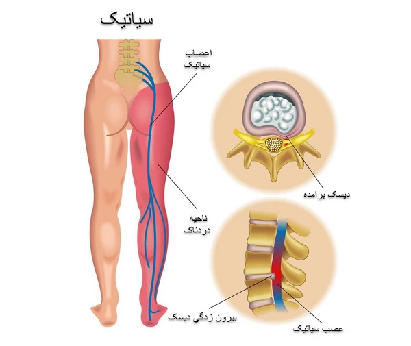 جکوزی برای سیاتیک